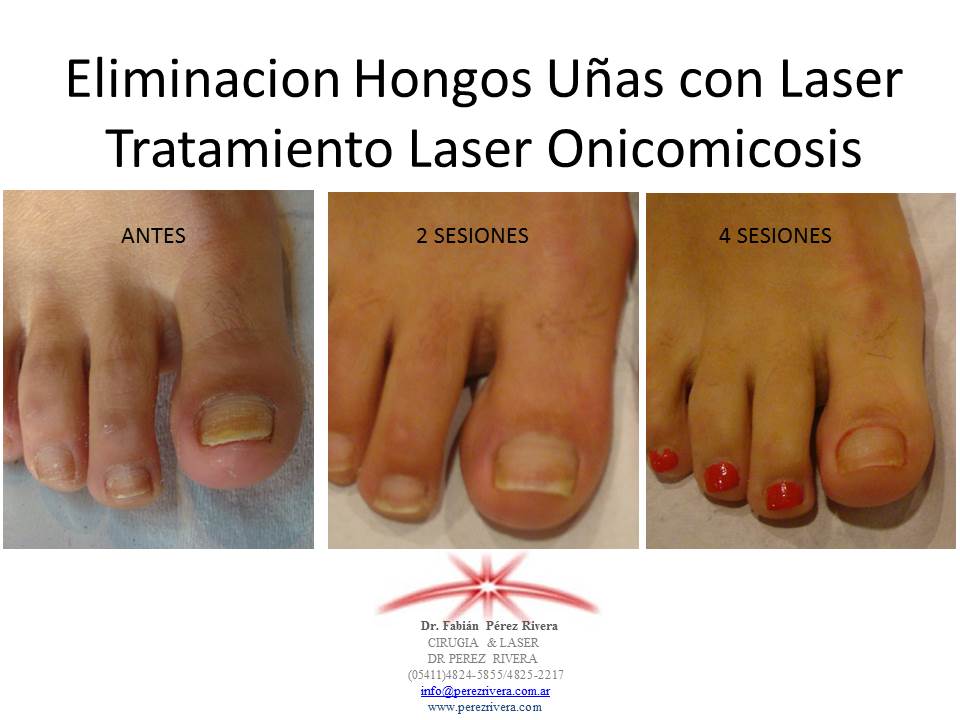 Tratamiento con Lser para Uas con Hongos